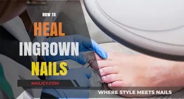 Effective Remedies and Tips to Heal Ingrown Nails Fast