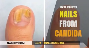 Healing Lifted Nails Caused by Candida: Effective Remedies and Tips