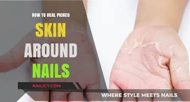 Heal and Restore: Effective Tips for Repairing Picked Skin Around Nails