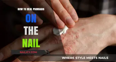 Effective Nail Psoriasis Healing: Tips and Treatments for Clear Nails