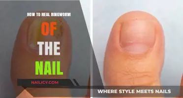 Effective Remedies to Heal Ringworm of the Nail Naturally and Fast