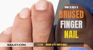 Heal Your Bruised Fingernail: Quick and Easy Home Remedies