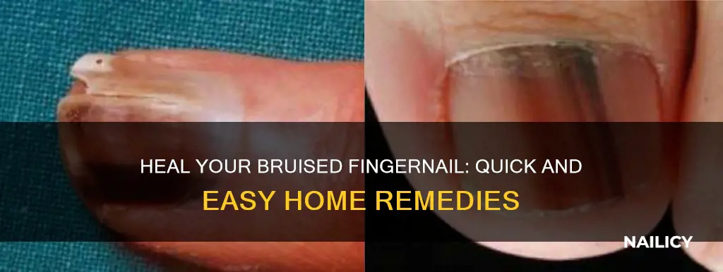 how to help a brused finger nail
