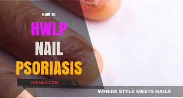 Effective Strategies to Manage and Treat Nail Psoriasis Successfully