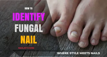 Spotting Fungal Nail Infections: Key Signs and Early Detection Tips