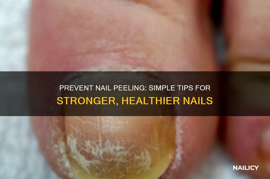 how to keep yourself from peeling your nails