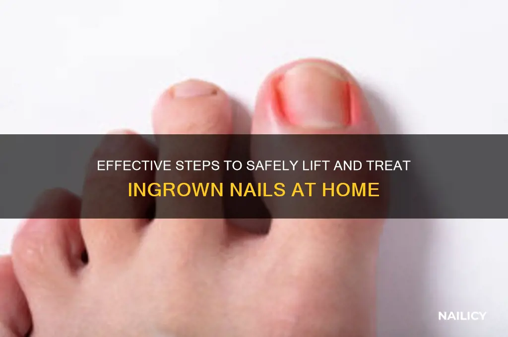 how to lift ingrown nail