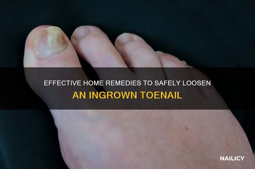 how to loosen ingrown nail