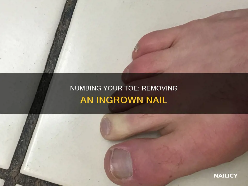 how to numb toe to remove ingrown nail
