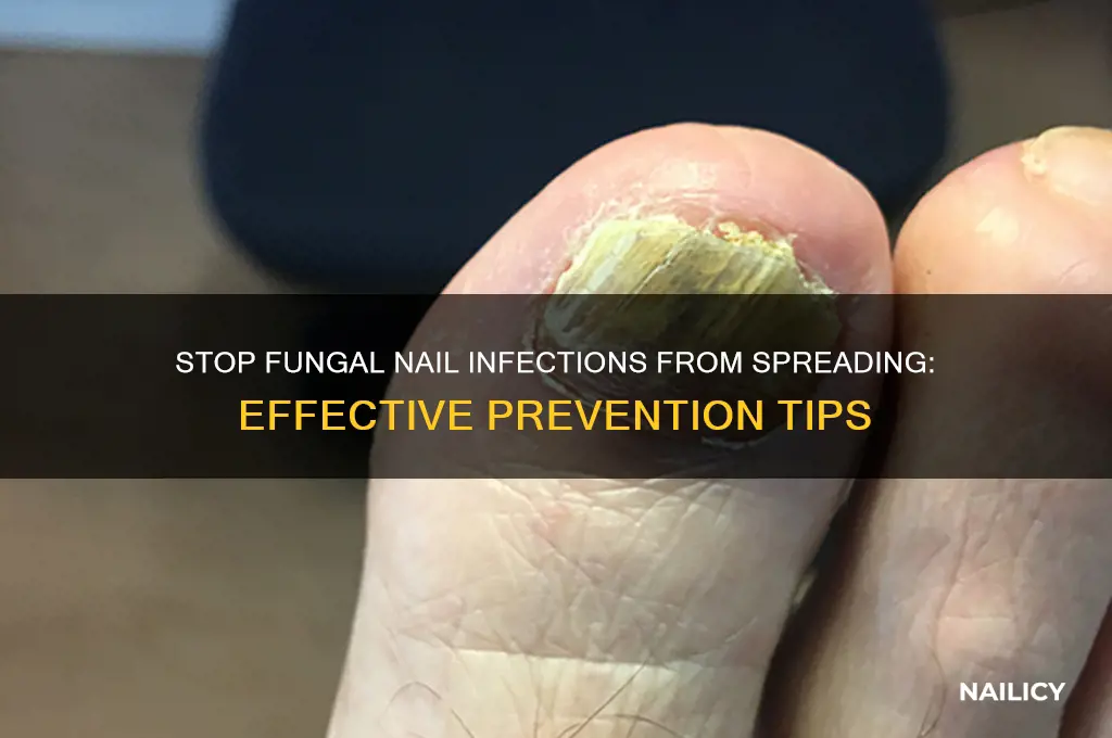 how to prevent fungal nail infections spreading