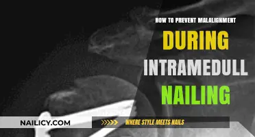Preventing Malalignment in Intramedullary Nailing: Essential Techniques and Tips