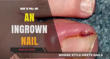 Effective Steps to Safely Remove and Treat Ingrown Nails at Home