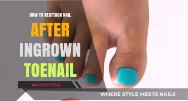 Reattaching Your Nail Post-Ingrown Toenail: A Step-by-Step Guide
