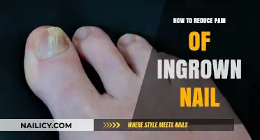 Effective Remedies to Alleviate Ingrown Toenail Pain and Discomfort