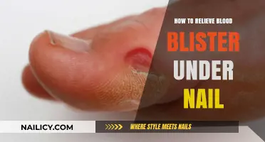Quick Relief Tips for Painful Blood Blisters Under Nails