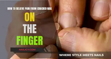 Relieving Pain from a Cracked Nail: Home Remedies and Tips