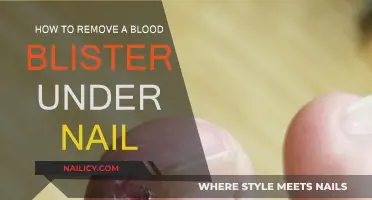 Treating Blood Blisters Under Nails: Quick Guide