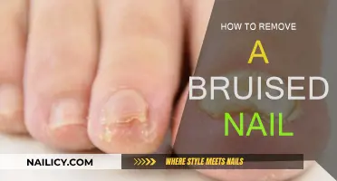 Treating a Bruised Nail: Effective Home Remedies