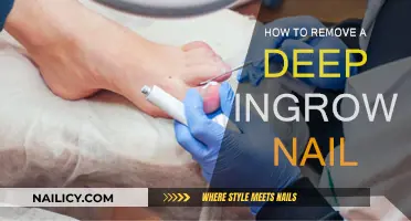 Expert Methods to Remove Deep Ingrown Nails