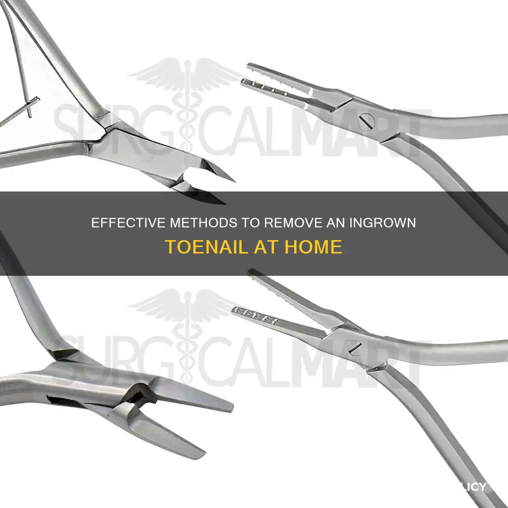 how to remove a incraved nail