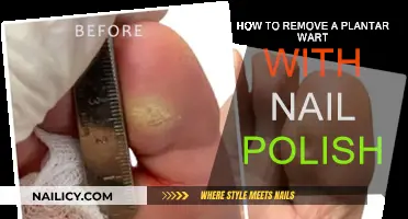 Effective Wart Removal: Nail Polish Application Technique