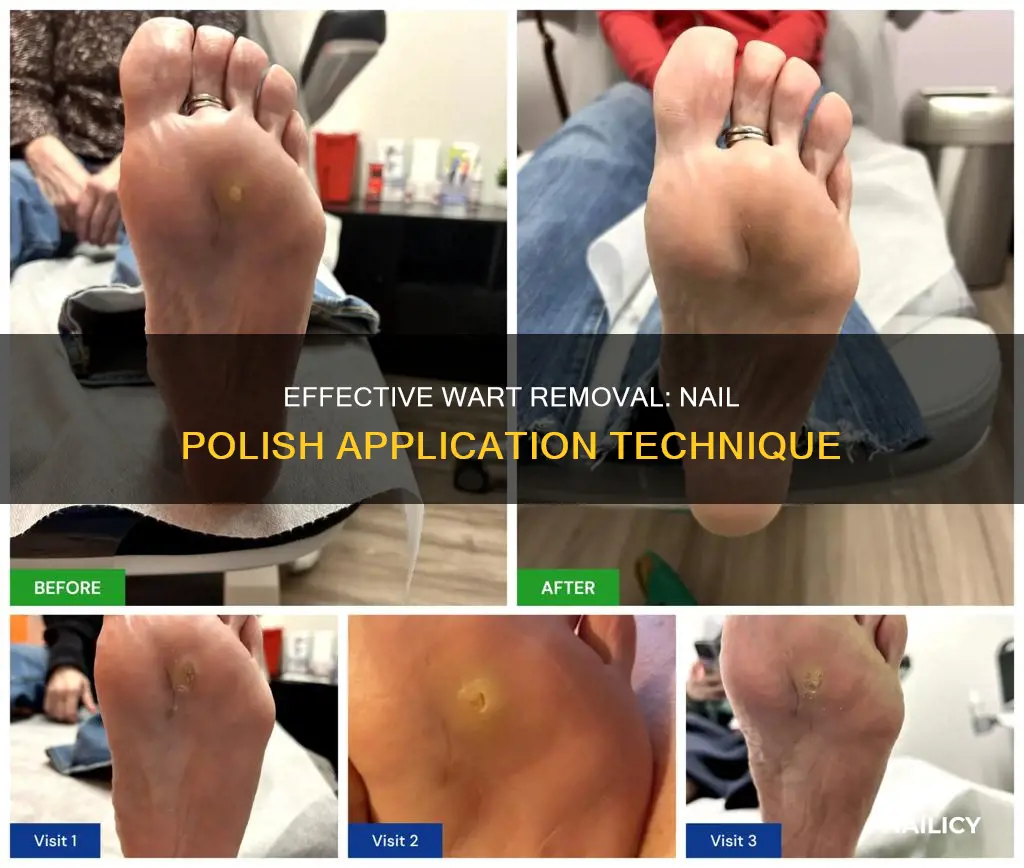 how to remove a plantar wart with nail polish