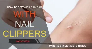 Easy Skin Tag Removal: Clippers for the Win