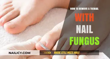 Eradicating Toenail Fungus: Removing the Infected Nail