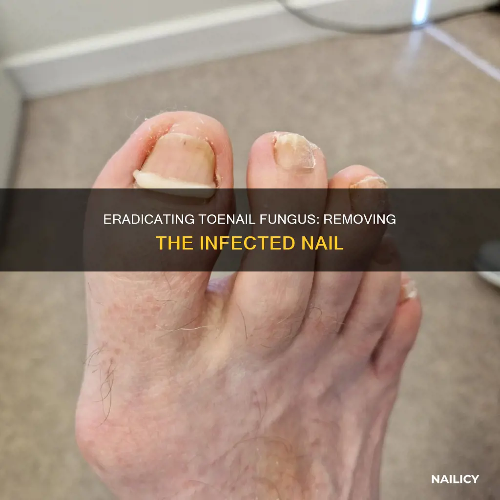 how to remove a toenail with nail fungus