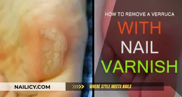 Effective Verruca Treatment: Nail Varnish Method