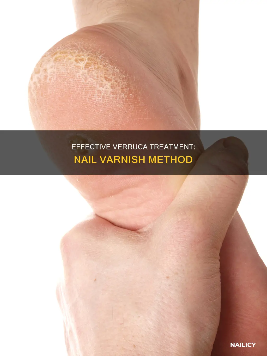 how to remove a verruca with nail varnish