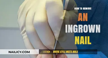 Expert Tips to Remove Ingrown Nails at Home
