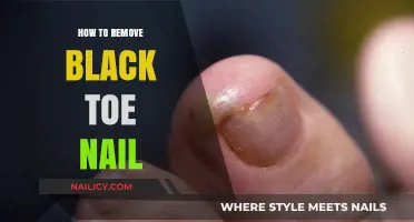 Effective Treatments for Black Toenail Removal