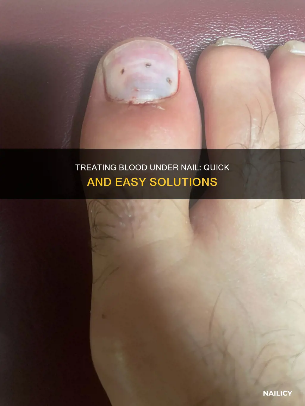 how to remove blood under nail