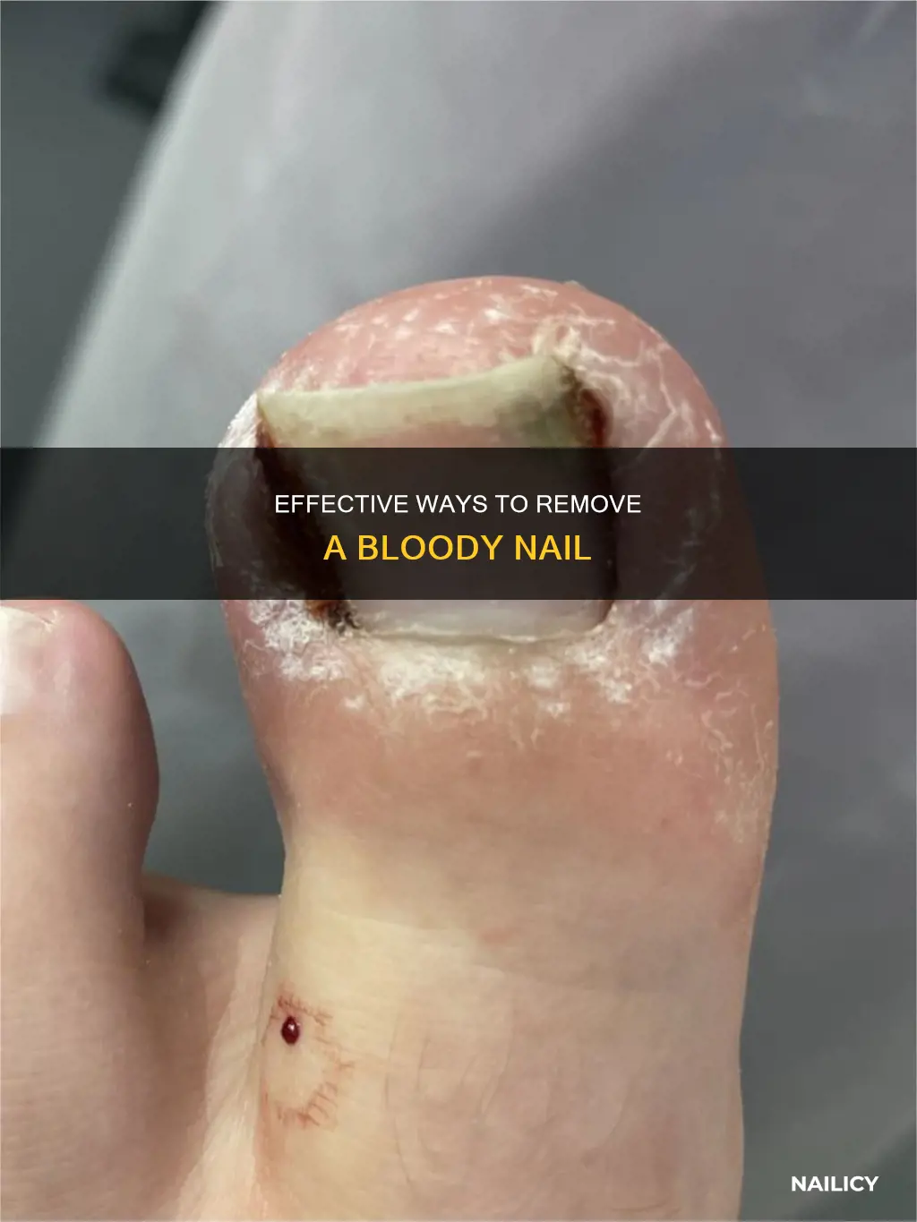 how to remove bloody nail