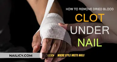 Get Rid of Blood Clots Under Nails