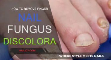 Eradicating Nail Fungus Discoloration: Effective Home Remedies