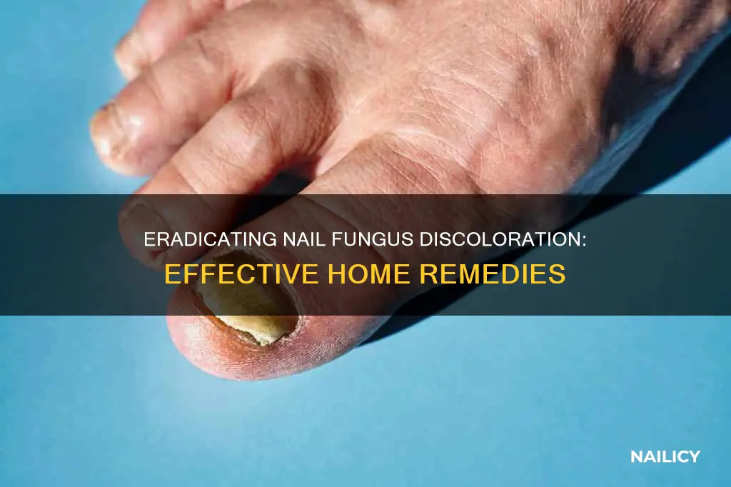 how to remove finger nail fungus discoloration