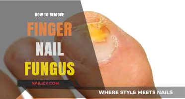 Eradicate Finger Nail Fungus: Effective Home Remedies