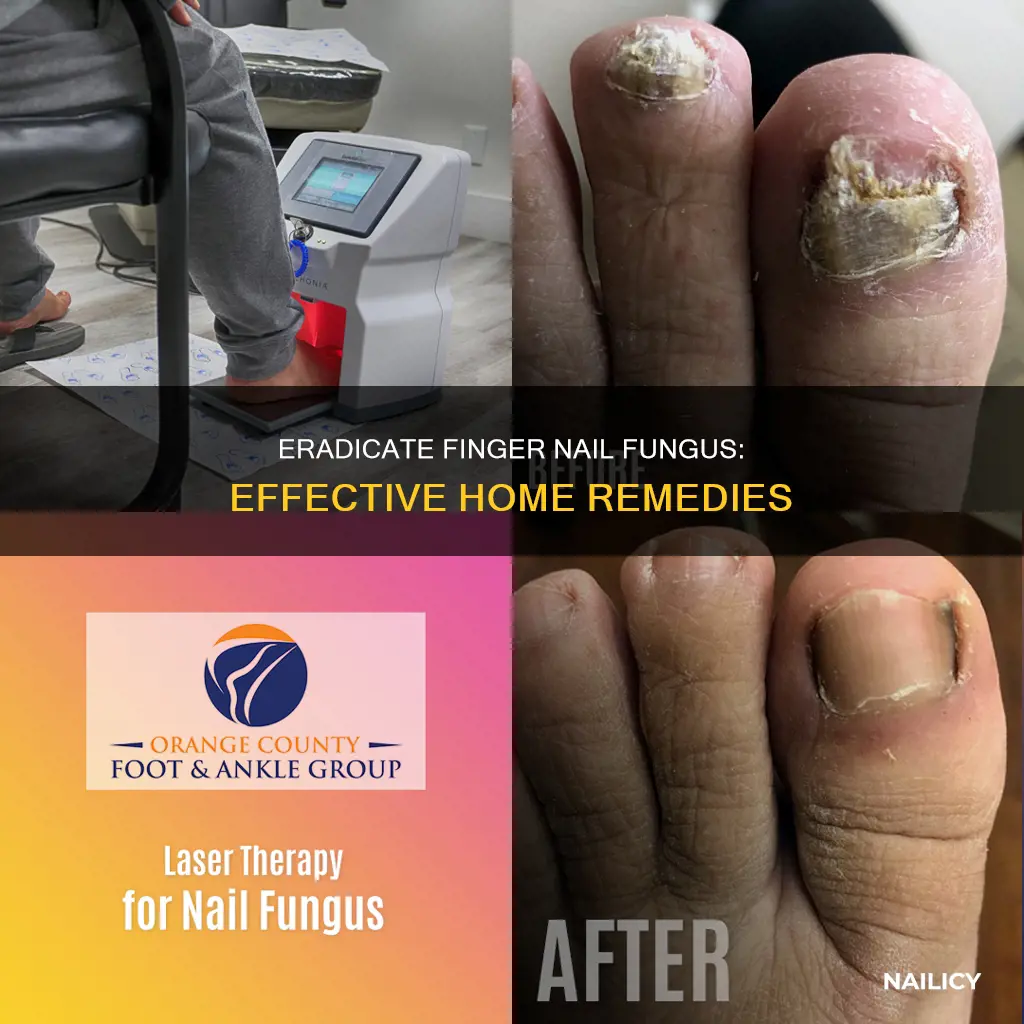 how to remove finger nail fungus