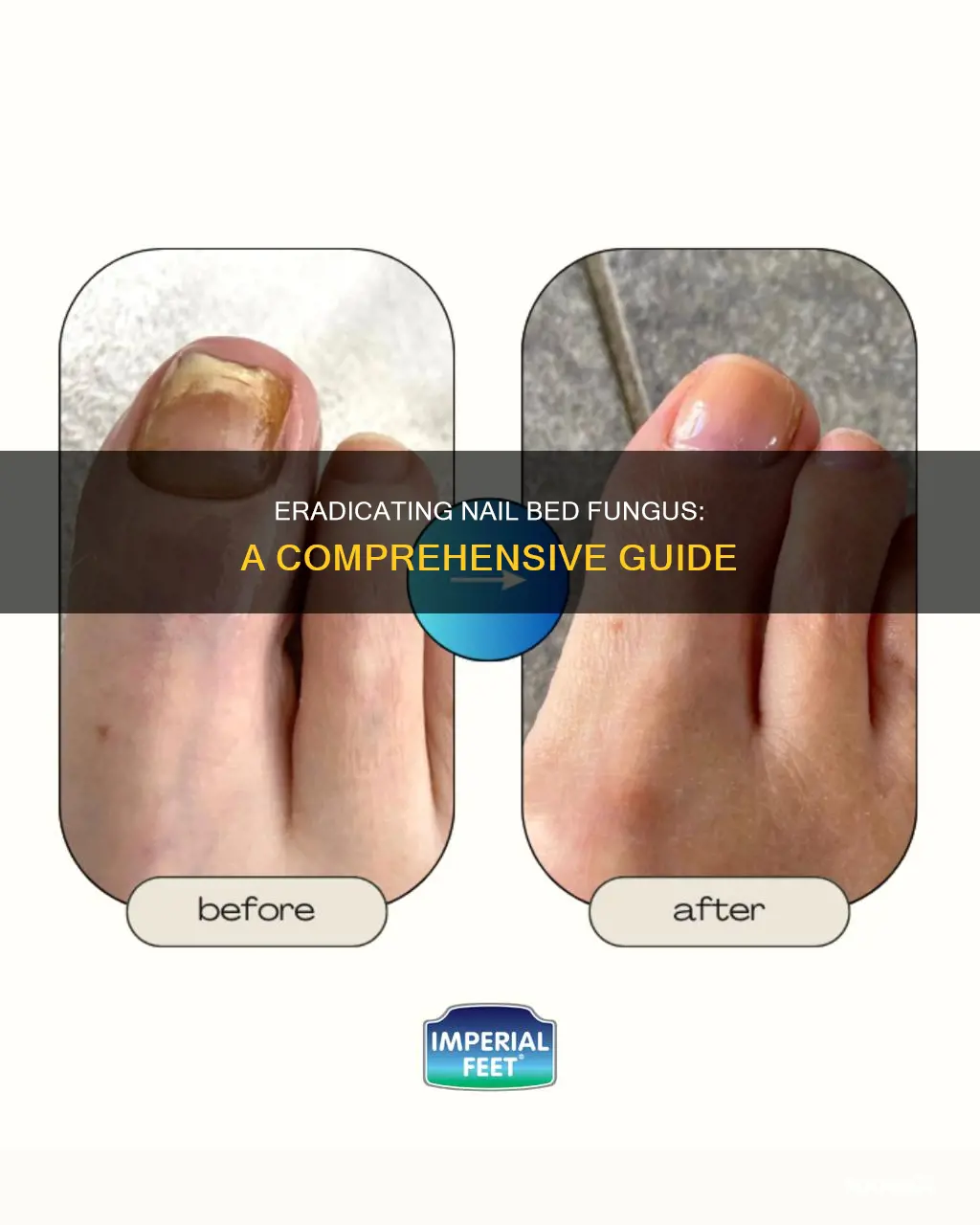 how to remove fungus from nail bed
