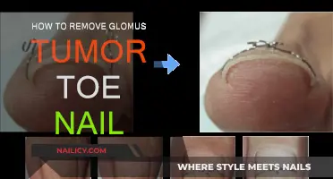 Effective Treatment for Glomus Tumor Under Toenail