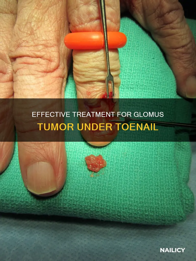 how to remove glomus tumor toe nail