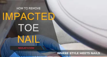 Relieving Impacted Toenails: Quick and Easy Solutions