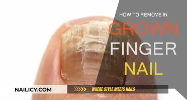 Get Rid of Ingrown Fingernails: Quick and Easy Steps