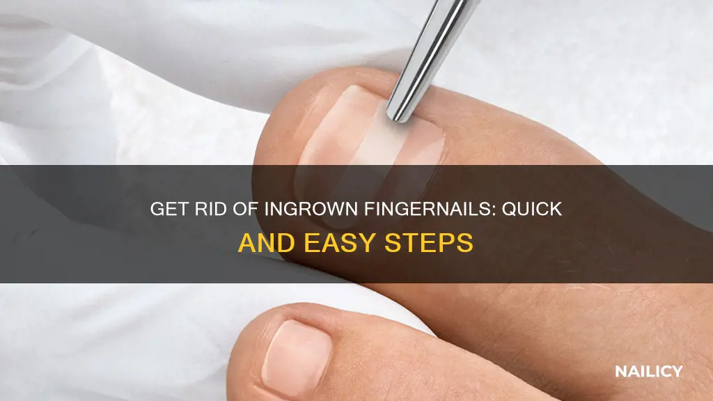 how to remove in grown finger nail