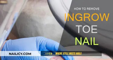 Get Rid of Ingrown Toenails: Quick and Easy Methods