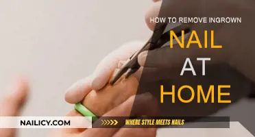 Home Remedies for Ingrown Nail Removal