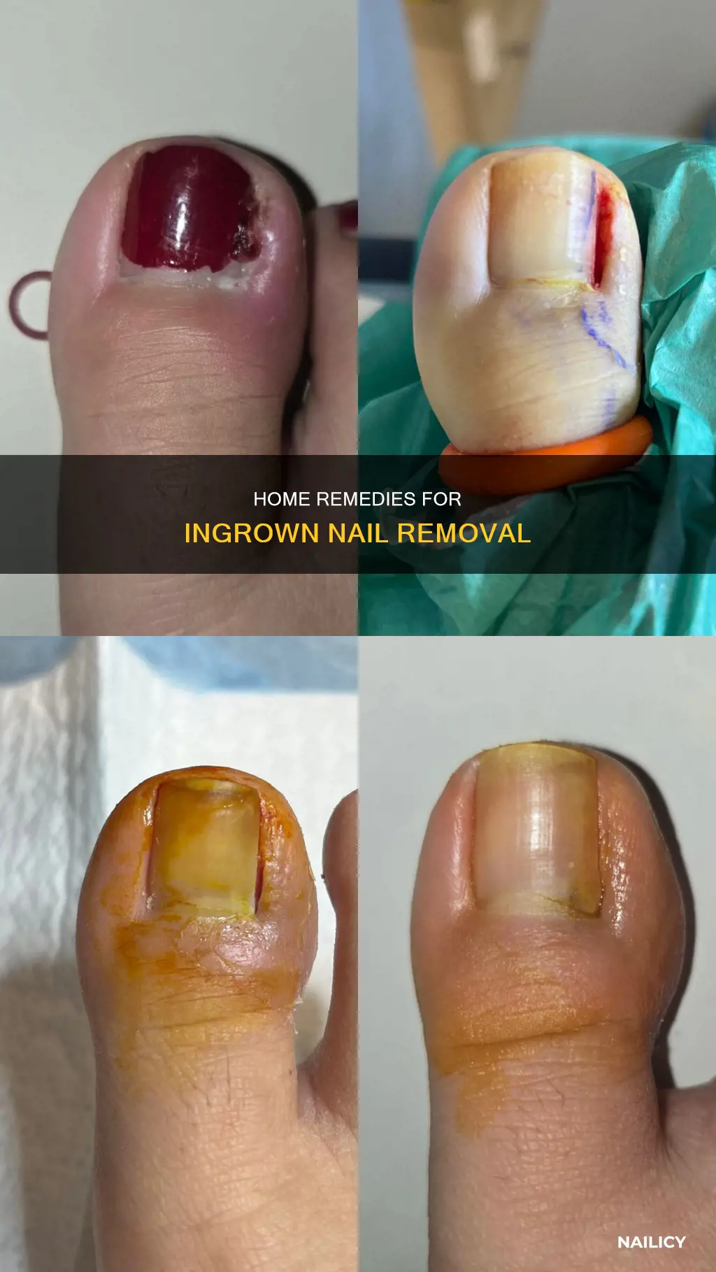 how to remove ingrown nail at home
