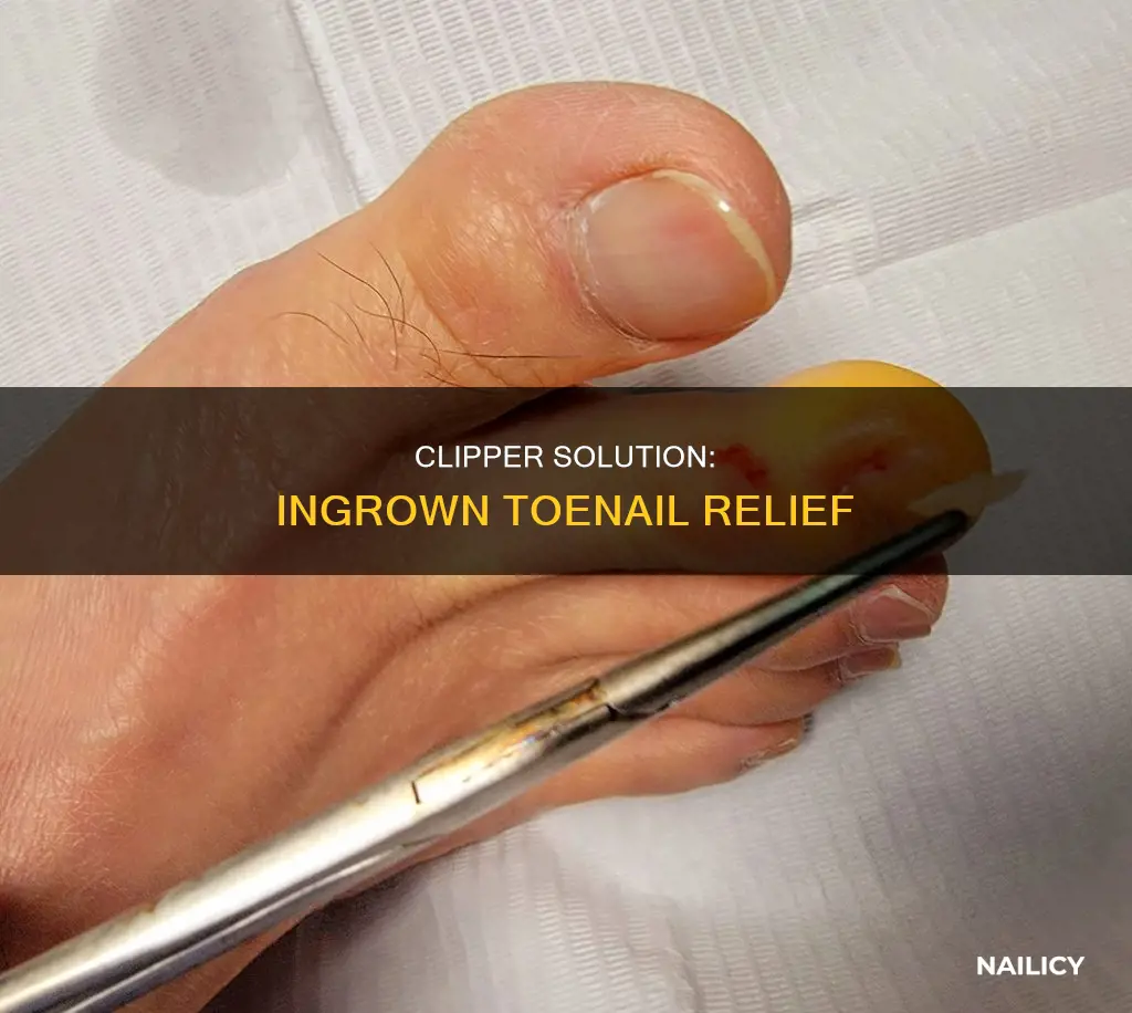 how to remove ingrown toenail with nail clippers